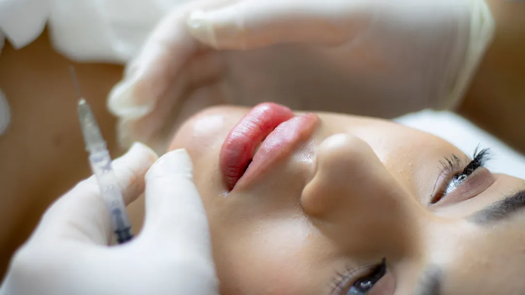 Nose and Lip Filler