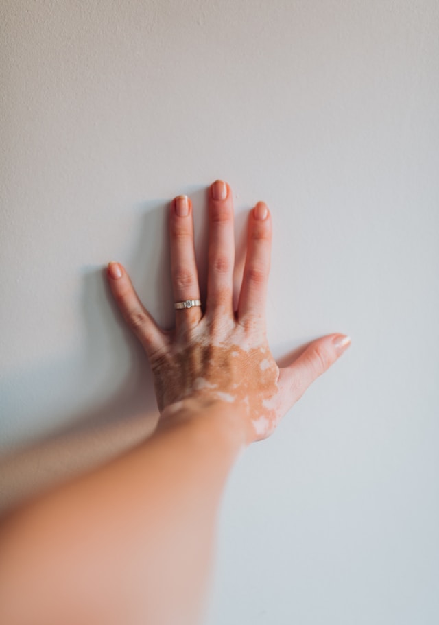 Vitiligo and Psychological Stress